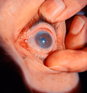 Trasplantes de córnea: una década devolviendo la vista en Baja California Sur